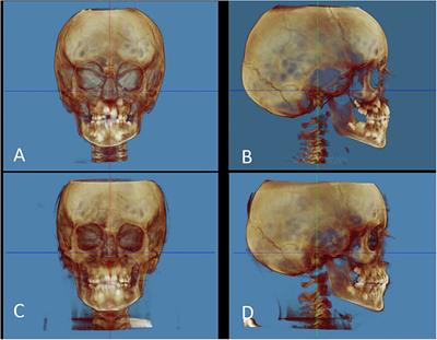 Three-dimensional evaluation using CBCT of the mandibular asymmetry and the compensation mechanism in a growing patient: A case report